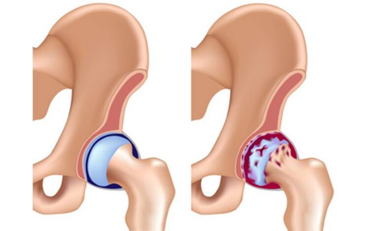 A healthy hip joint and a joint affected by arthritis