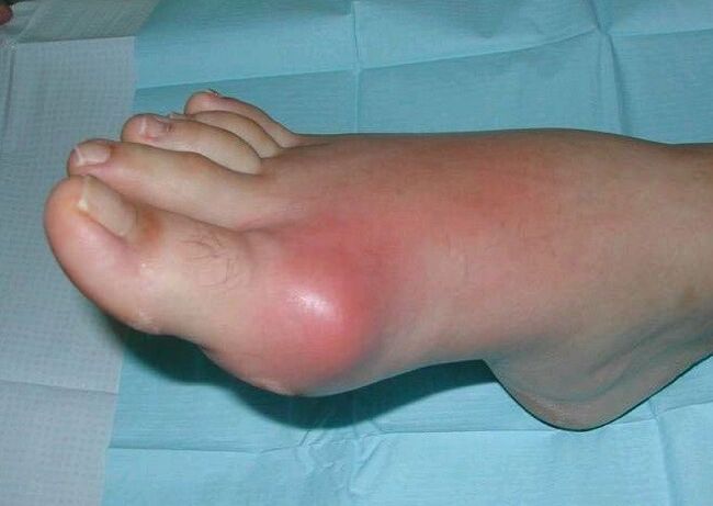 Clinical picture of foot arthritis - swelling