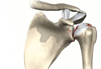 The shoulder joint is affected by arthritis