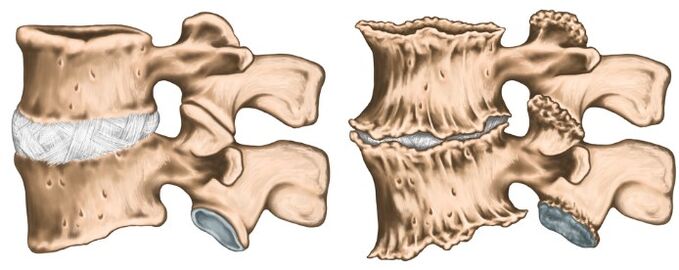 Healthy and destroyed joints