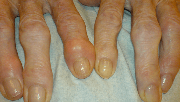 Finger joint pain due to osteoarthritis