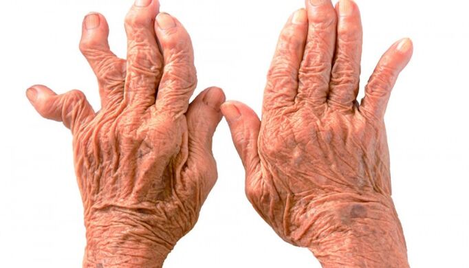 Rheumatoid arthritis is the cause of pain in finger joints