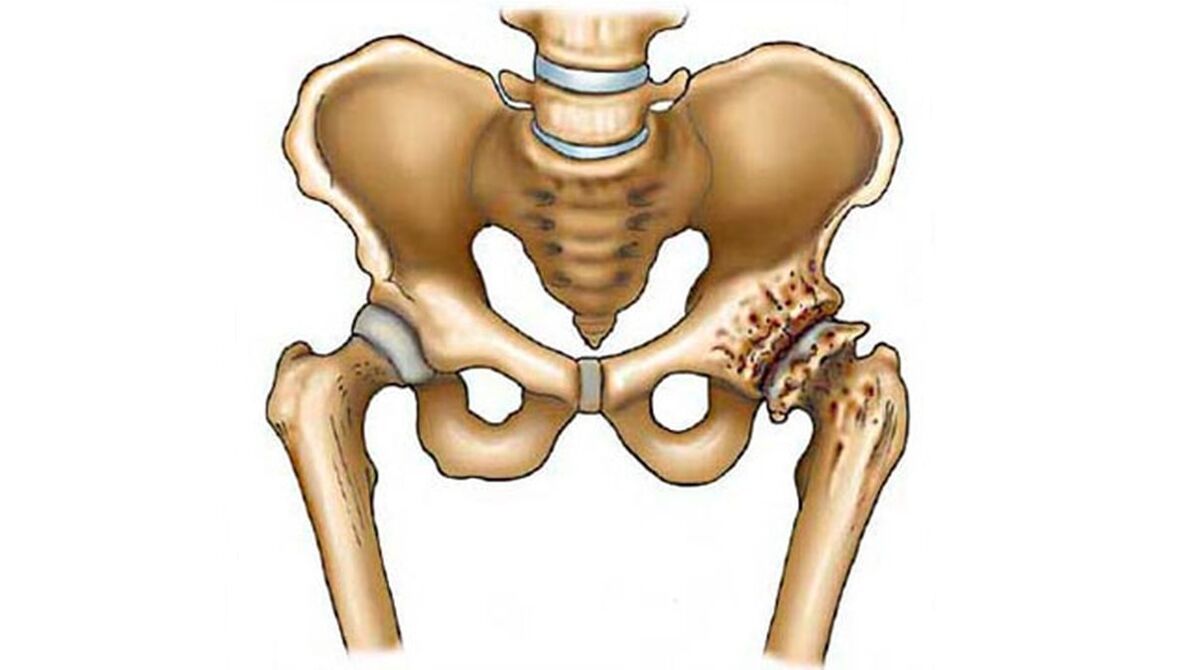 hip joint damage when there is joint disease