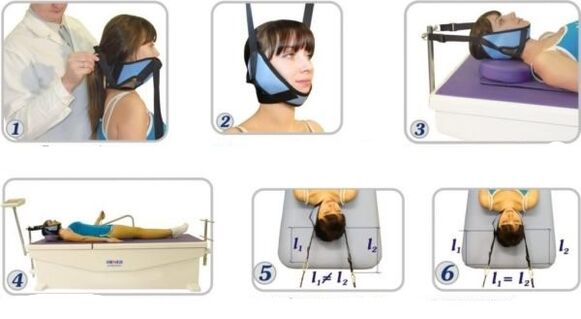 Treatment of cervical spondylosis using traction method