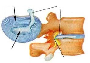 destruction of the annulus fibrosus in cervical spondylosis