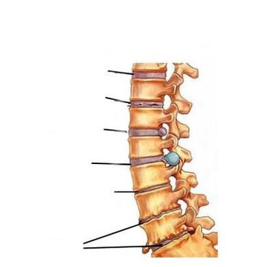 stages of development of osteoarthritis