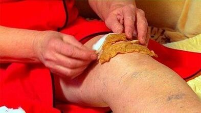 Compression for knee joint disease