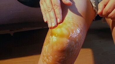Trash to treat knee joint disease