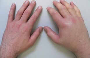 Joint pain is the cause of pain in the finger joints