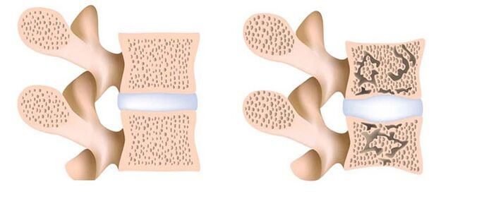 Osteoporosis - removal of calcium from the bones