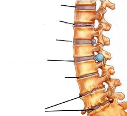 stages of development of osteonecrosis of the spine