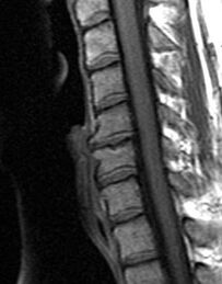 X-ray of the thoracic spine