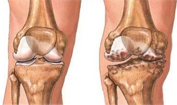 Knee joint pain