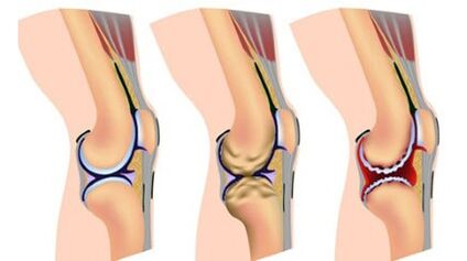 Three severity of the disease