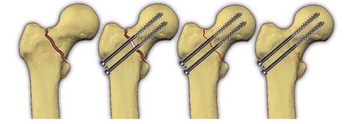 Fix the body with pins to treat hip pain