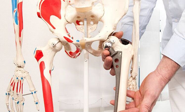 hip arthroplasty to relieve pain