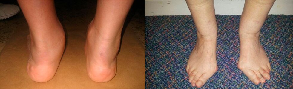 Arthritis of the big toe and deformity of the ankle joint