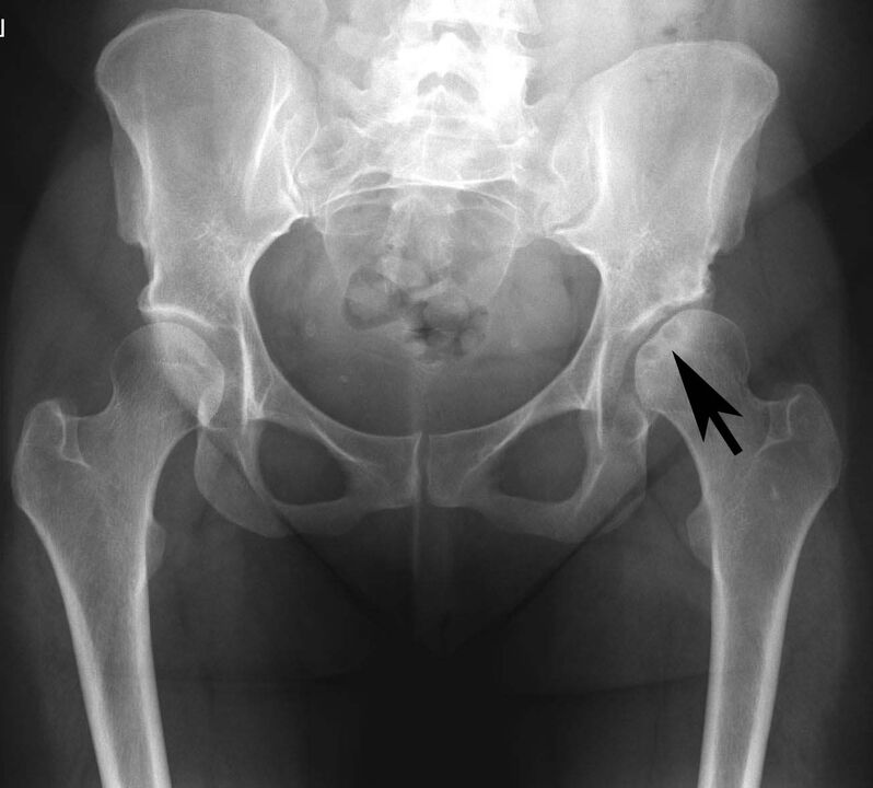 Calcium salt deposition in the hip joint with false images on X-ray