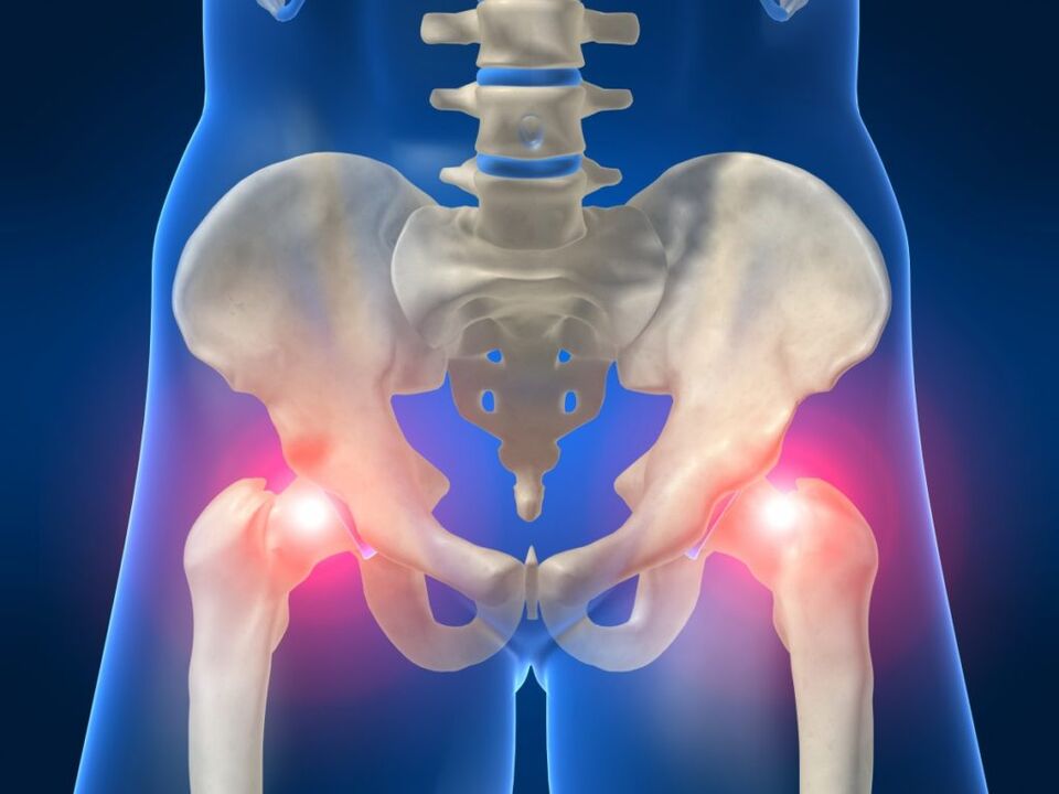 In ankylosing spondylitis, pain on both sides of the hip bothers