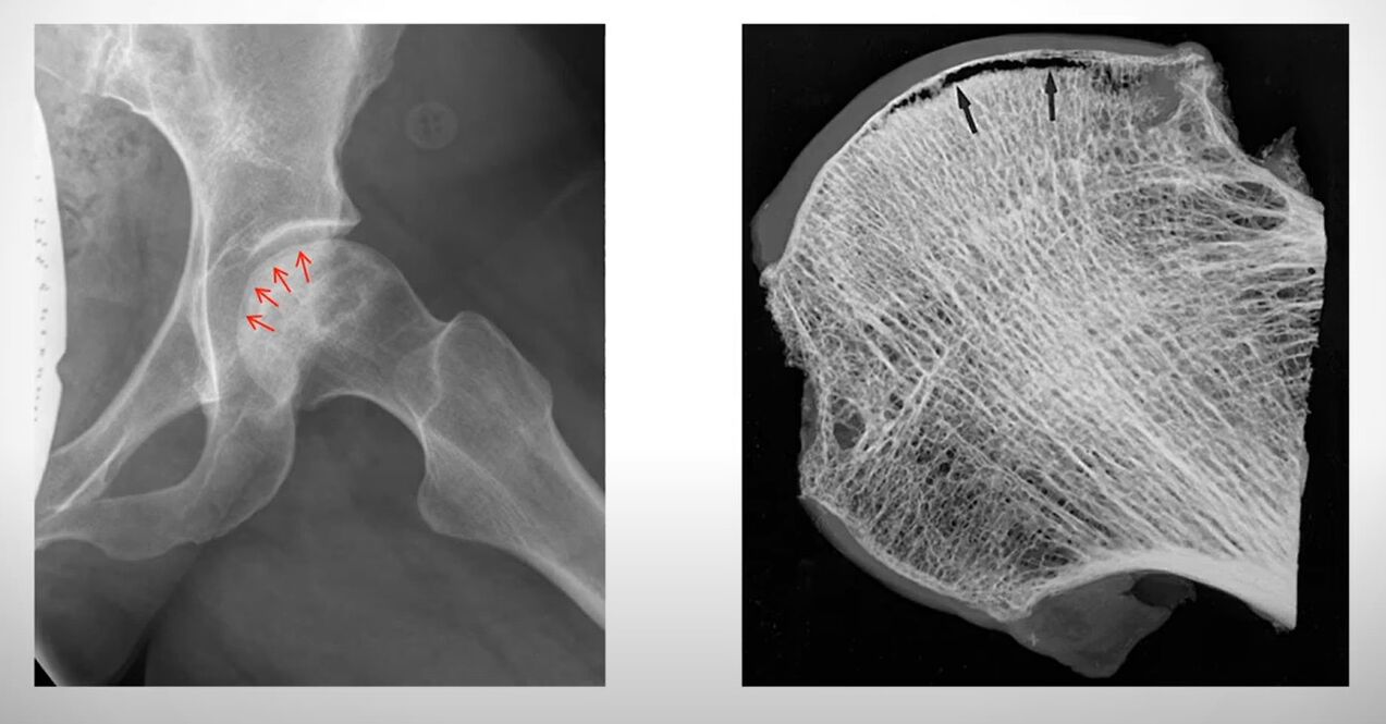 X-ray of the femoral head with sterile necrosis